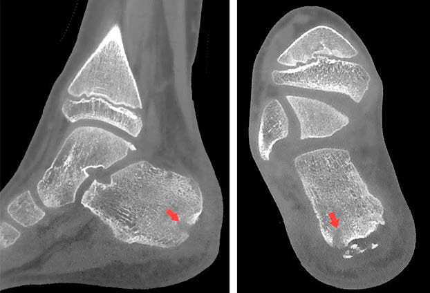 КЛК-томограммы правой пяточной кости